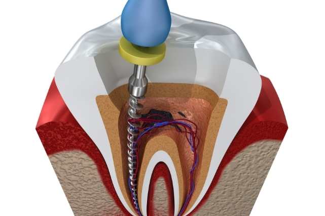 root canal 3D image by shubhdin dental clinic in mumbai.