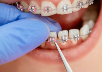 teeth and jaw correcting braces for kids and adults