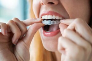 Invisible braces treatment in Grant road at shubhdin dental clinic gamdevi mumbai