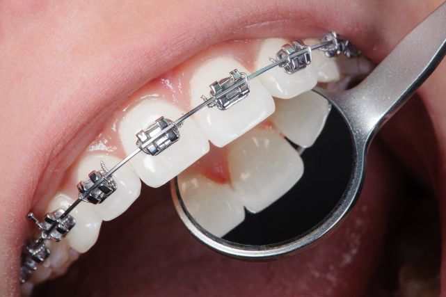 braces treatment at shubhdin dental clinic in grant road