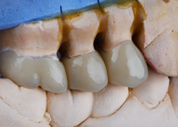 Dental Crowns and bridges