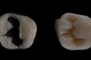 how does cavity looks after cavity removal